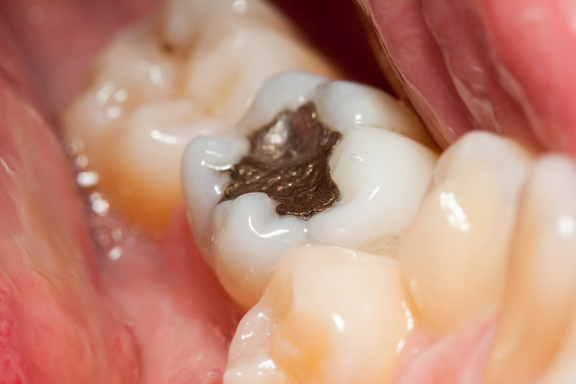 Usave amalgam filling